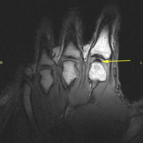 MRI of knuckle
